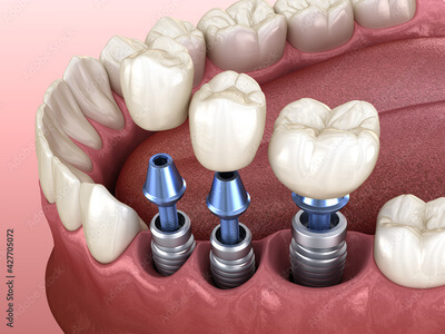 Implantes Múltiplos