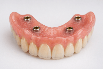 Prótese Overdenture