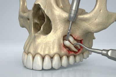 Remoção de Dentes Inclusos Mordent