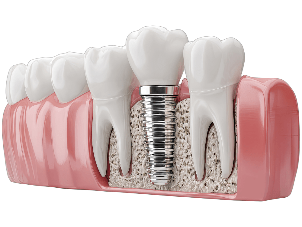 Ilustração em corte mostra implante dentário fixado no osso entre dentes naturais, explicando a base do implante zigomático.
