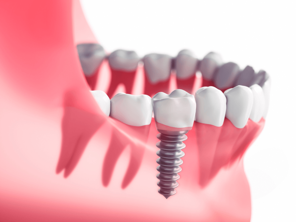 Modelo tridimensional exibe implante dentário integrado ao osso e à gengiva, ilustrando a reabilitação oral com implantes.