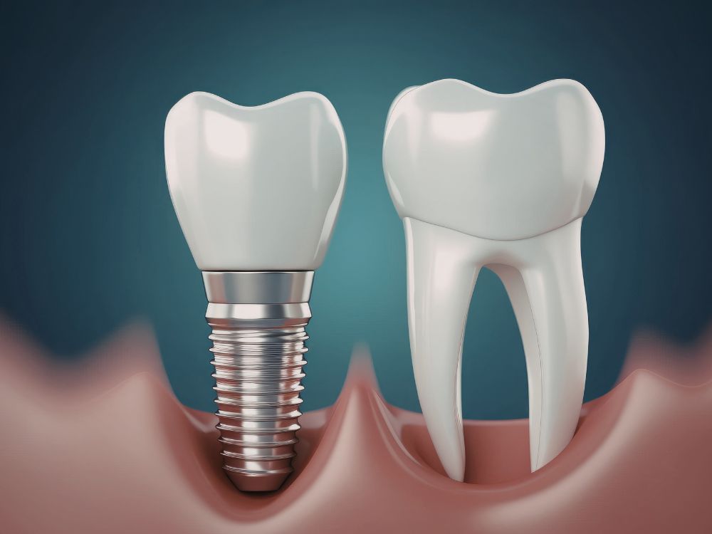 Representação visual do melhor tipo de implante dentário ao lado de um dente natural para comparação estética.