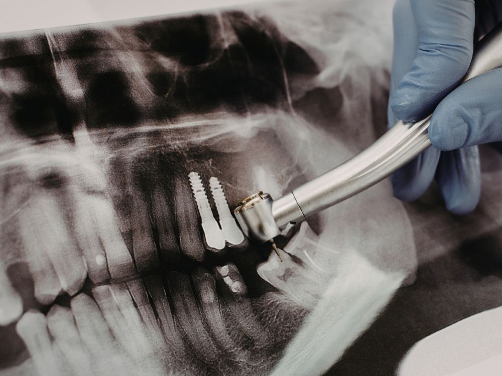 Equipamento odontológico apontando para implantes em raio-x dental, representando o que é implante zigomático e sua aplicação em casos específicos.