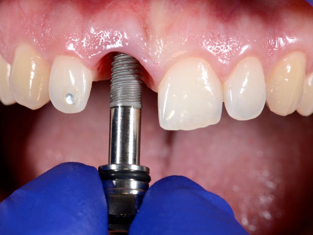 O implante dentário é seguro