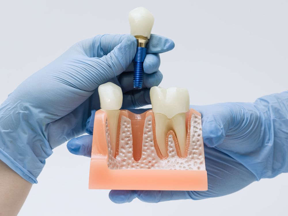 O implante dentário é seguro