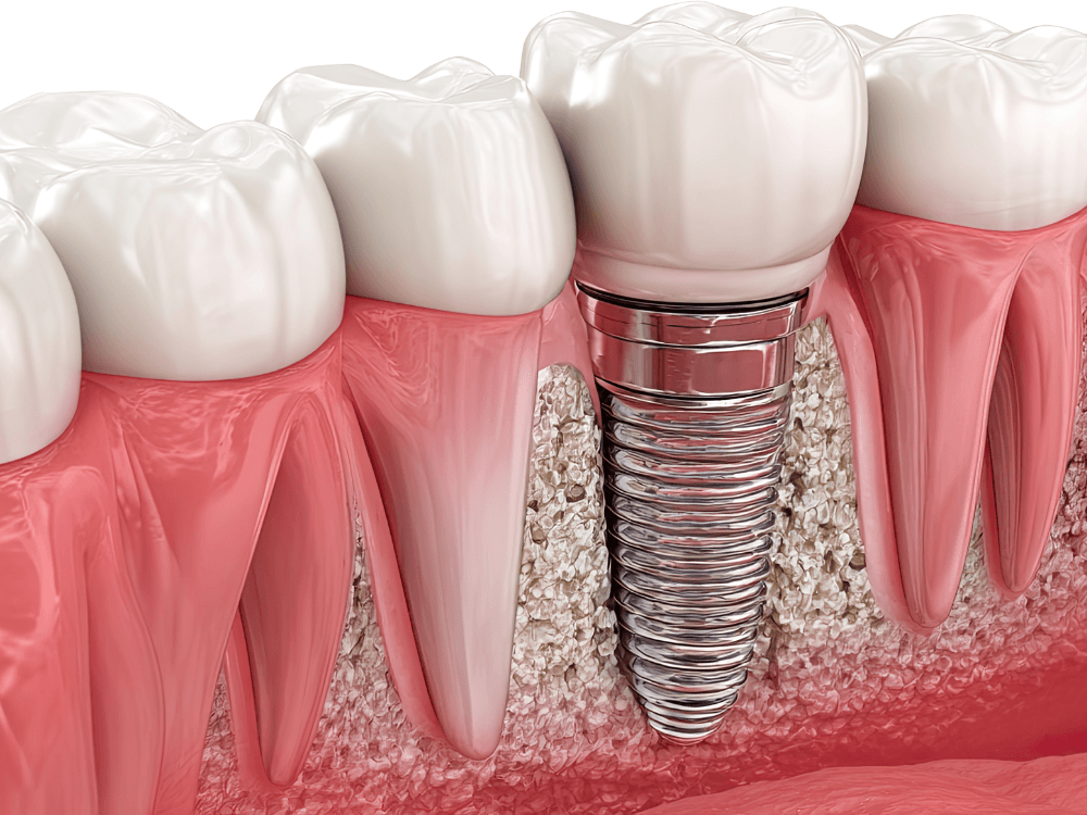 Ilustração 3D apresenta implante dentário integrado ao osso e à gengiva, destacando a base que sustenta a coroa protética.