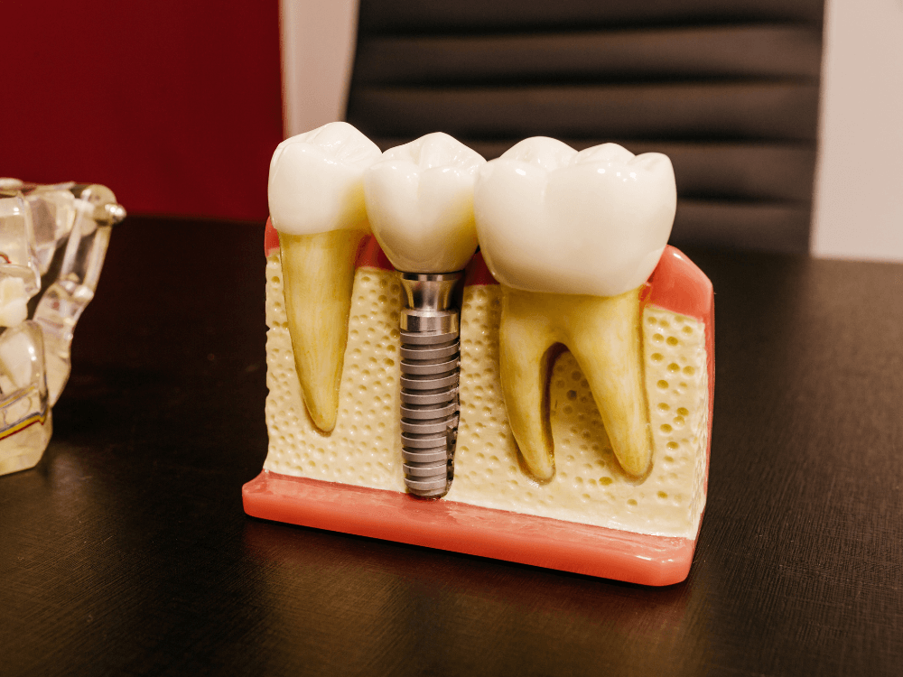 Modelo anatômico mostra estrutura de implante dentário com coroa protética para explicar diferentes técnicas de reabilitação oral.