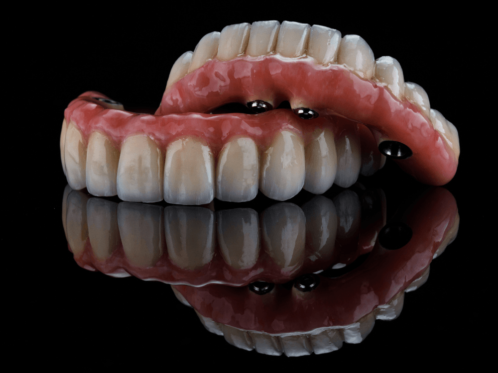 Prótese dentária fixa sobre implantes com estrutura gengival rosada e dentes cerâmicos, opção para reabilitação do sorriso.