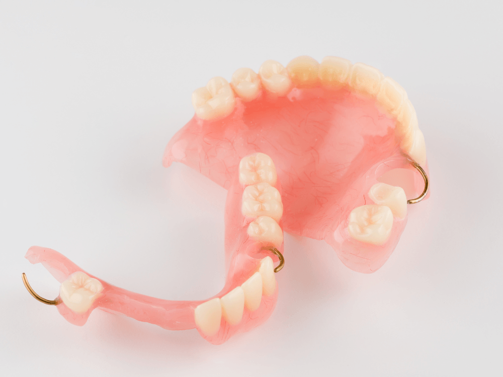 Prótese parcial removível com grampos metálicos e base rosada utilizada para substituir dentes ausentes.