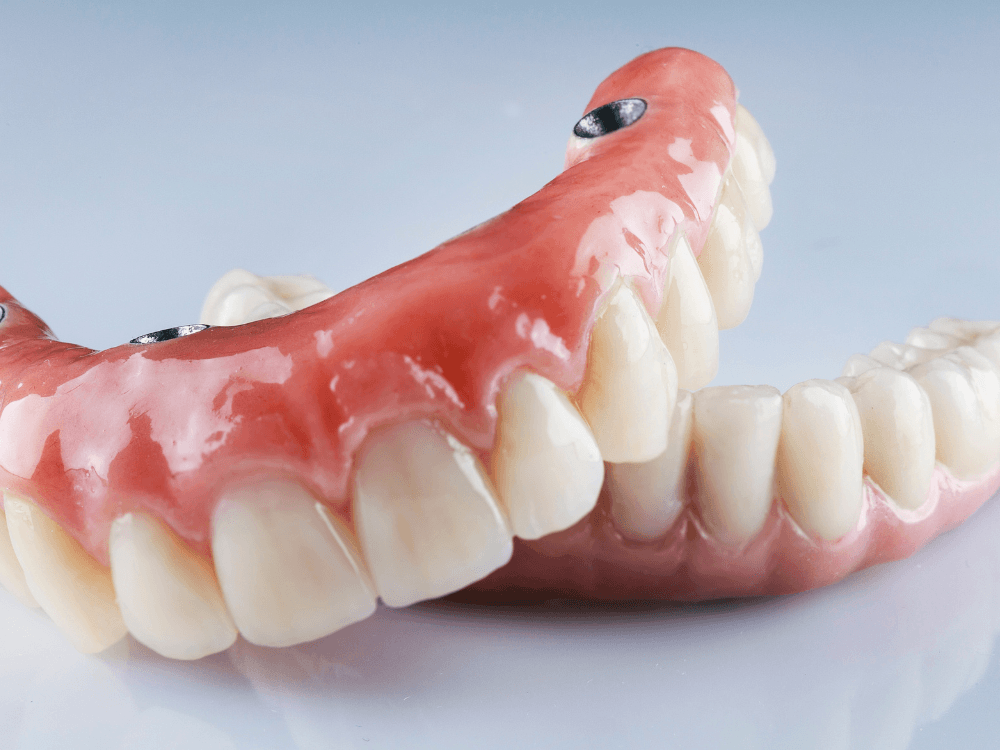 Prótese dentária completa apoiada em implantes metálicos, alternativa moderna para restaurar a arcada superior.