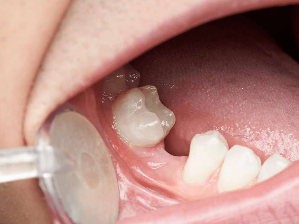 Avaliação odontológica mostra a região posterior da boca, destacando um dente e o espaço da arcada durante o exame. Tudo para explicar como substituir um dente perdido.