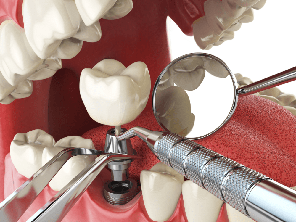 Ilustração mostra a colocação de uma coroa sobre implante dentário com instrumentos odontológicos durante o procedimento