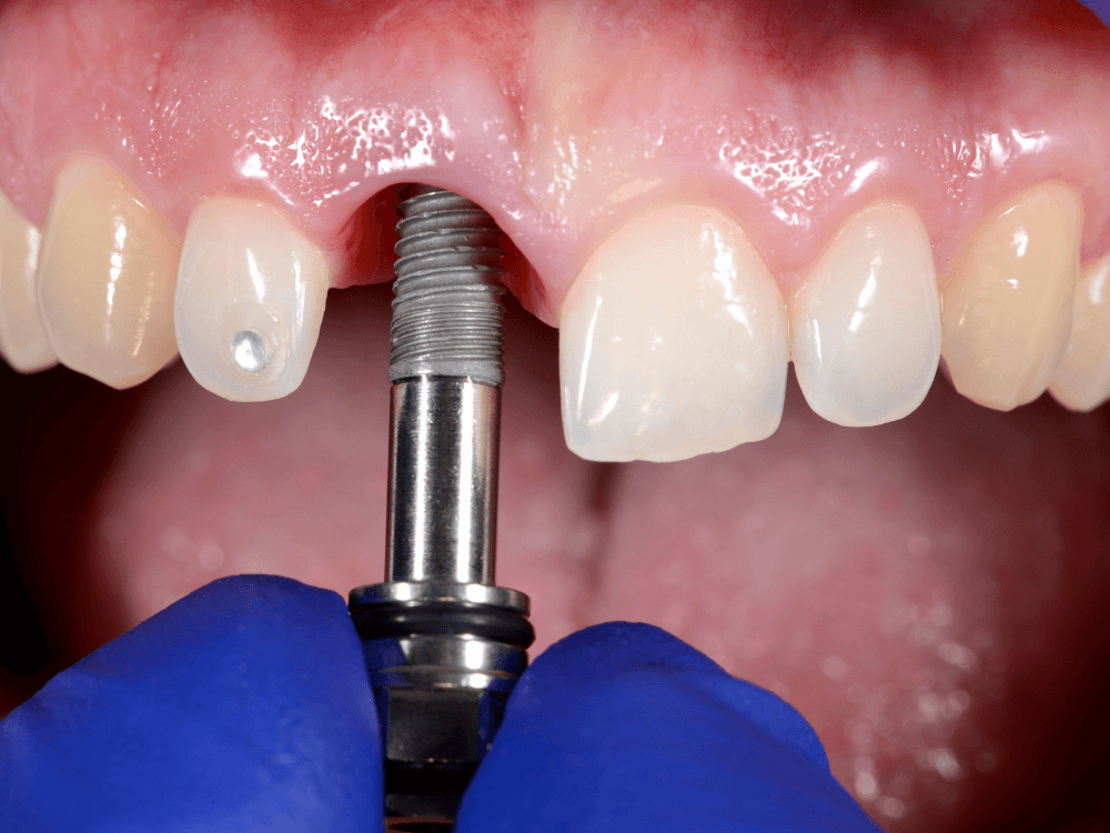 Procedimento odontológico mostra a instalação de um componente sobre implante dentário antes da colocação da prótese definitiva