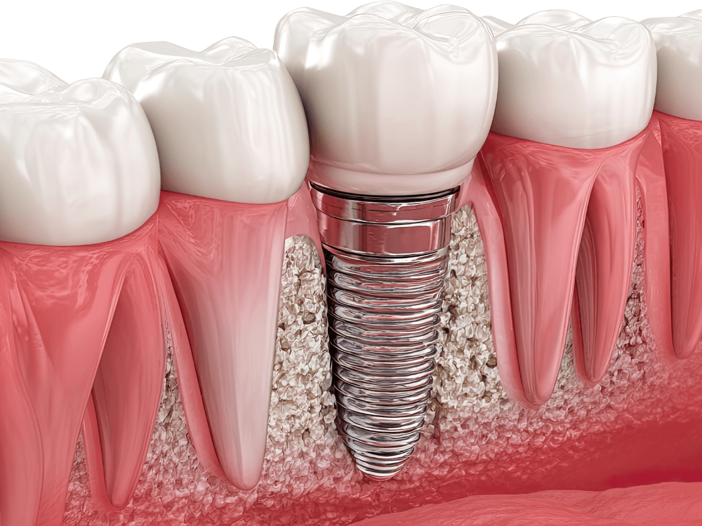 Ilustração mostra um implante dentário integrado ao osso e conectado à coroa que representa o dente definitivo. Tudo para explicar quanto tempo depois do implante pode colocar o dente definitivo.
