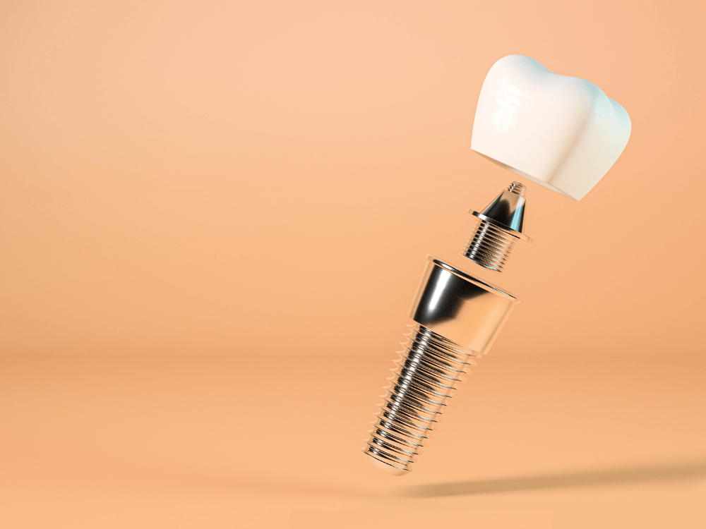 Ilustração de implante dentário desmontado com coroa branca, intermediário metálico e pino rosqueado de titânio sobre fundo laranja.