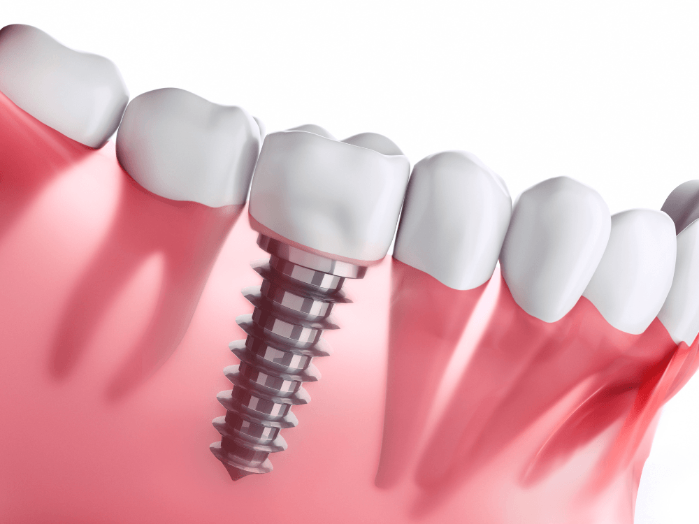 Modelo 3D de implante dentário com pino metálico rosqueado e coroa branca, inserido na gengiva entre dentes naturais.