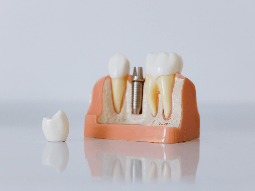 Modelo anatômico de mandíbula com implante dentário metálico, dentes artificiais e uma coroa separada sobre a superfície.