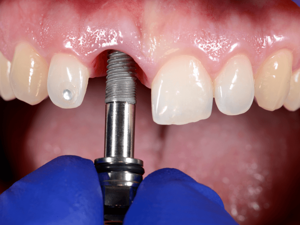 Close-up de implante dentário metálico posicionado na gengiva entre dentes naturais, ilustrando uma etapa do tratamento odontológico. Tudo para explicar se o pós implante dentário dói