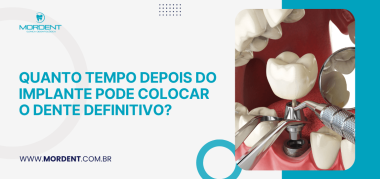 Arte sobre implante dentário destaca a dúvida sobre quanto tempo esperar para colocar o dente definitivo