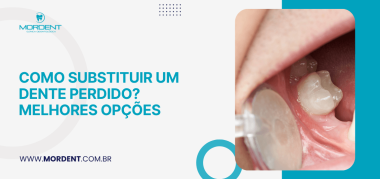 Capa de artigo sobre como substituir um dente perdido apresenta o tema e uma imagem da região posterior da boca